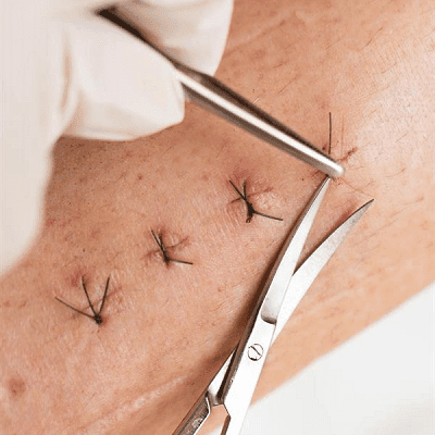 Suture Removal & Dressing